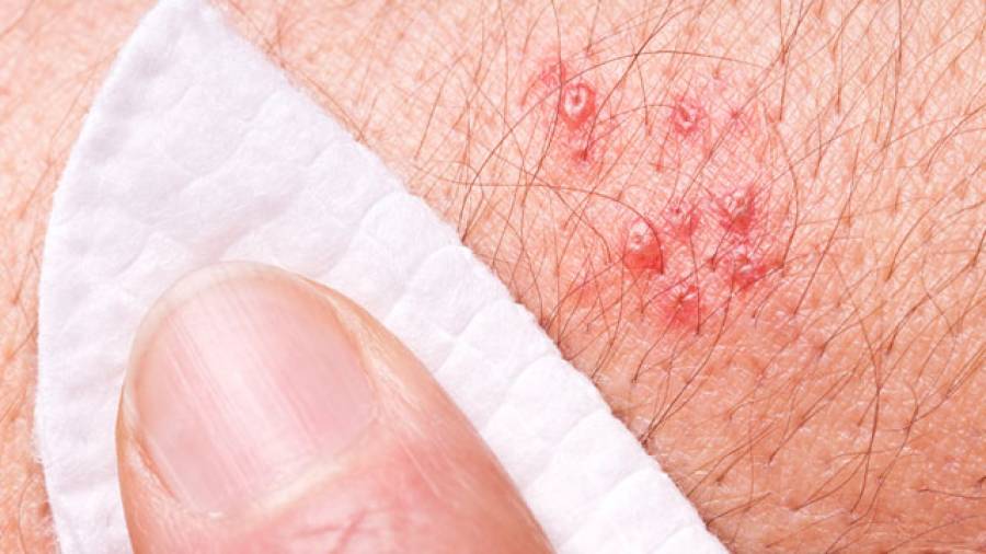 What is a rash in the shape of a circle on your skin - Answers