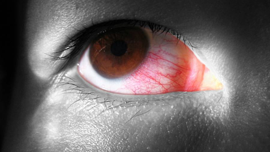 Rote Augen – die Bindehautentzündung
