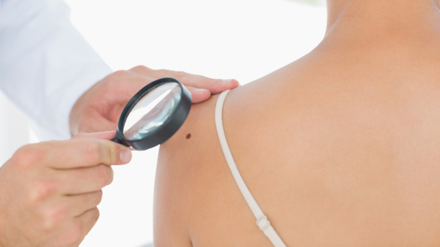 Hautkrebs – So erkennst Du gefährliche Muttermale