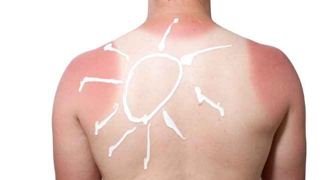 Empfindliche Kinderhaut - Jugendlicher Sonnenbrand erhöht Krebsgefahr