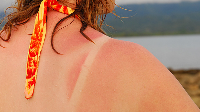 Wenn die Haut brennt – Sofortmaßnahmen bei Sonnenbrand