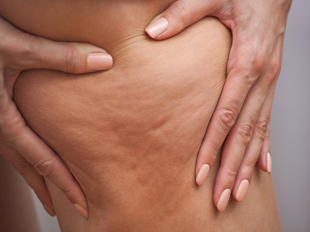 Unterschied cellulite cellulites